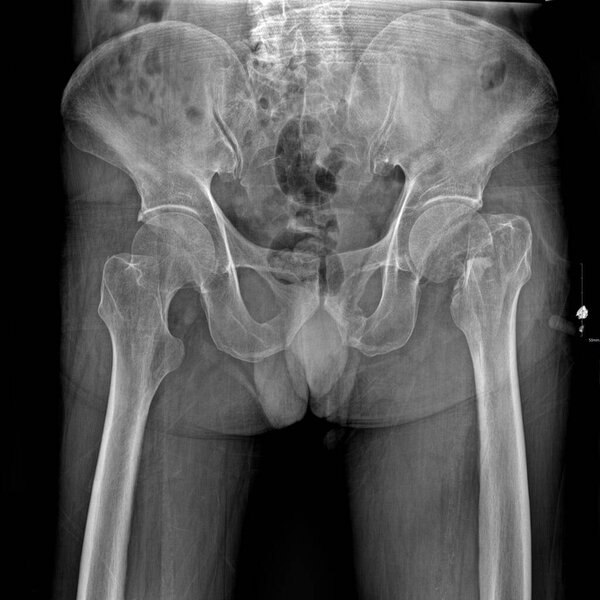 An x-ray showed both hips and pelvis, revealingA femoral fracture is a fracture of the upper portion of the femur.