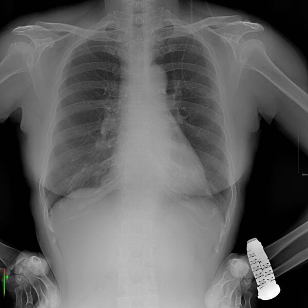 An X-ray of the body showing a foreign object resembling a watch.