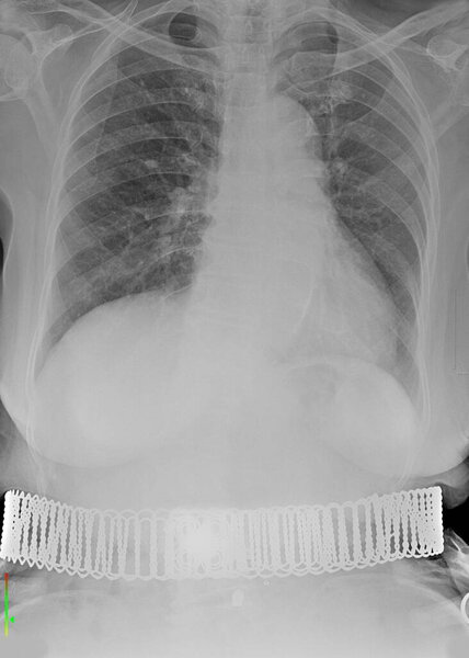 An X-ray of the body showing a belt-like foreign body.