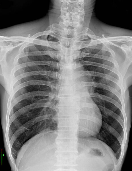 This image shows a chest X-ray used to evaluate the lungs, heart, and chest wall. It can help diagnose conditions such as pneumonia, emphysema, cancer, and heart problems.