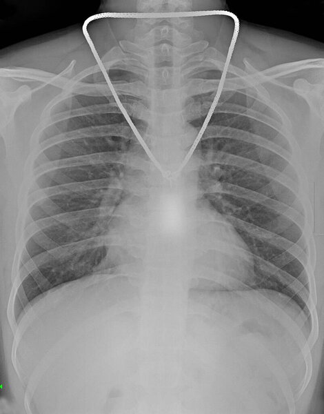 A chest X-ray (CXR) image shows X-rays to visualize the structures and organs within the chest, including the lungs, heart, and chest wall, and the presence of a necklace-like object.