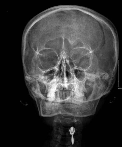 This image shows a skull radiograph.