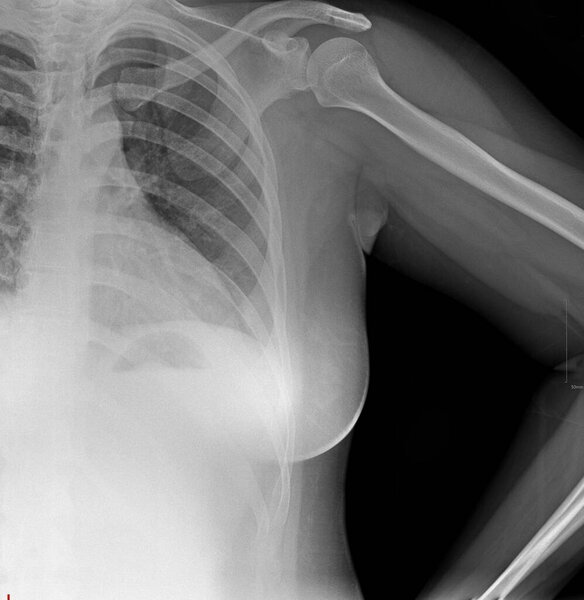 The image shows a shoulder X-ray, which is a diagnostic imaging test used to visualize the bones and joints of the shoulder.