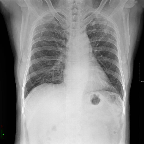 The image displays a chest X-ray, which is a common medical imaging technique used to visualize the internal structures of the chest.