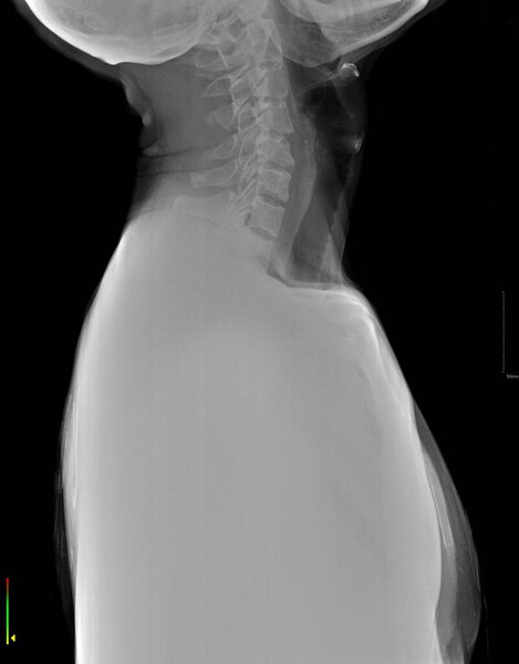 This image is a lateral X-ray of the cervical and upper thoracic spine, likely showing a case of scoliosis.