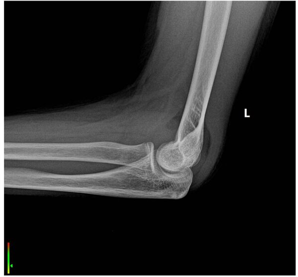 This image is a lateral X-ray of the elbow, revealing a fracture at the elbow.