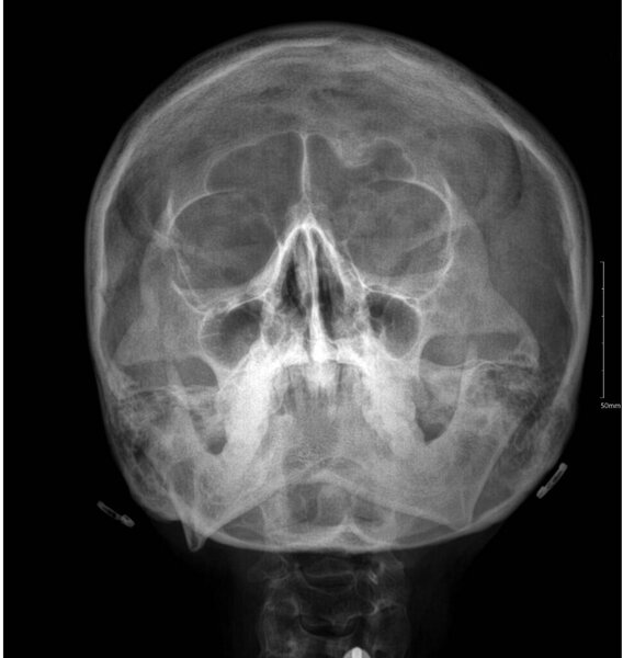 This image shows a Caldwell view of the skull, a view used to examine the sinuses, particularly the maxillary sinus.
