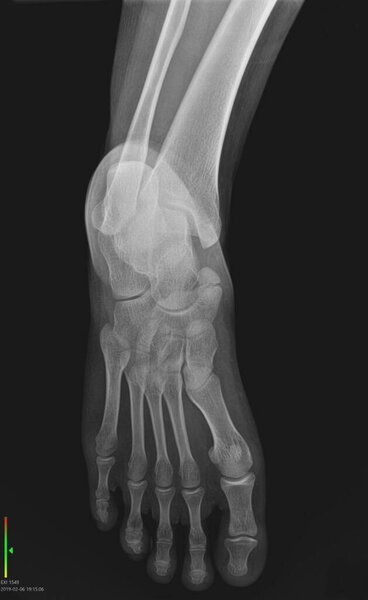 This image shows an X-ray of the human foot, likely taken from an anteroposterior (AP) or oblique view, showing the bones of the foot, including the tarsals, metatarsals, and toe bones.