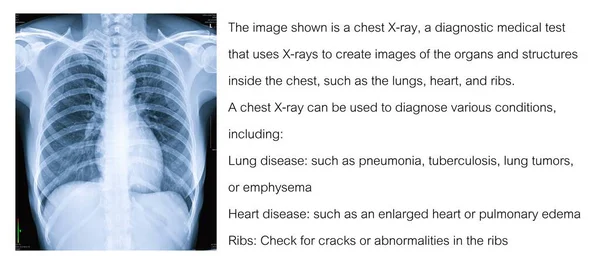 The image shown is a chest X-ray, a medical diagnostic test that uses X-rays to create images of the organs and structures inside the chest.