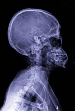 Side X-ray images for diagnosis.