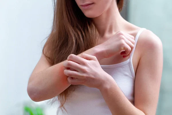 Молода жінка, яка страждає сверблячкою на шкірі і подряпає Ліцензійні Стокові Зображення