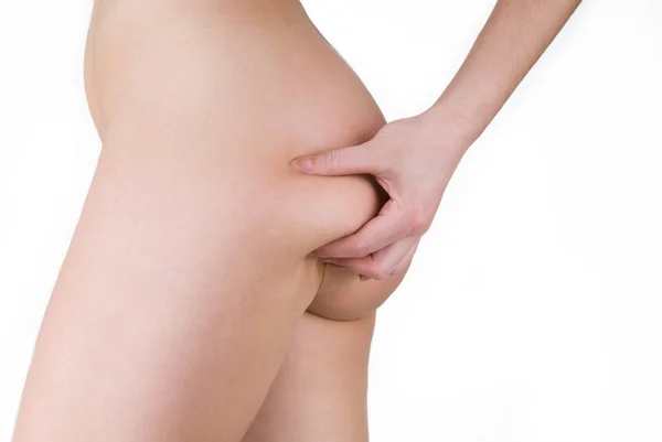 Celulitis en las nalgas — Foto de Stock