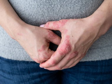 Cracked, flaky skin on the hands. Dermatological problems of psoriasis. Hard, horny and cracked skin on the finger in a woman's hands. Hand stains, dry skin. Psoriasis, allergy clipart