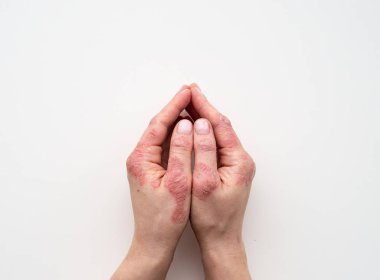 Sedef deri. Döküntü ve hastanın cilt üzerinde ölçekleme closeup. Kronik hastalık tedavi kavramı. Dermatolojik sorunları. Sert, azgın ve kırık Cilt kadının elinde. Kuru Cilt. İzole