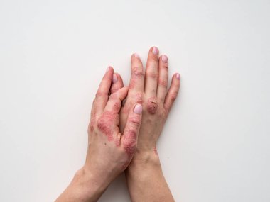 Sedef deri. Döküntü ve hastanın cilt üzerinde ölçekleme closeup. Kronik hastalık tedavi kavramı. Dermatolojik sorunları. Sert, azgın ve kırık Cilt kadının elinde. Kuru Cilt. İzole