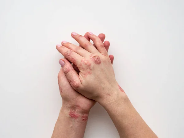 Psoriasis skin. Closeup of rash and scaling on the patient\'s skin. The concept of chronic disease treatment. Dermatological problems. Hard, horny and cracked skin in woman\'s hands. Dry skin. Isolated