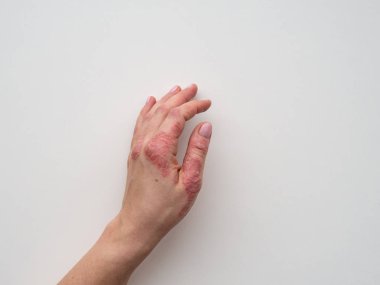 Sedef deri. Döküntü ve hastanın cilt üzerinde ölçekleme closeup. Kronik hastalık tedavi kavramı. Dermatolojik sorunları. Kadın eli sert, azgın ve kırık Cilt. Kuru Cilt. İzole.