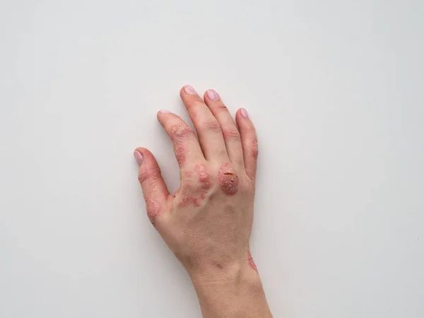牛皮癣皮肤 特写镜头皮疹和缩放病人的皮肤 慢性病治疗的概念 皮肤科问题 角质和裂开的皮肤在女人的手 皮肤干燥 — 图库照片