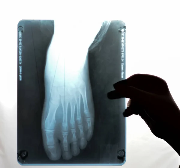 Ayağın x-ışını görüntüsü. Çocuklarda düz ayaklar.