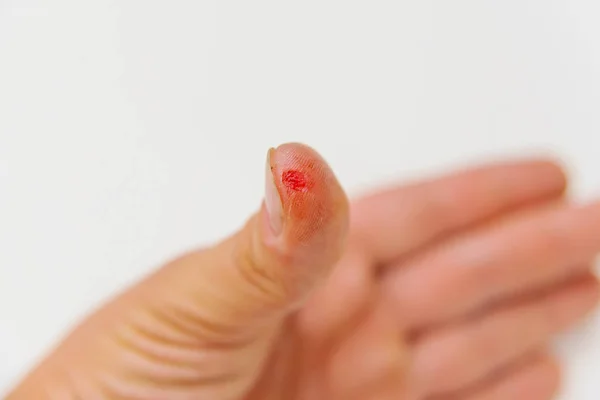 Τραύμα Στο Δάχτυλο Scarlet Αίματος Σχετικά Τον Αντίχειρα Μια Αλοιφή — Φωτογραφία Αρχείου