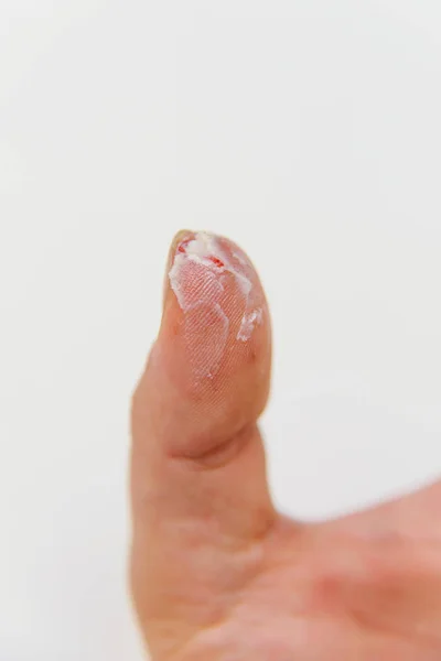 手指受伤了拇指上有红血割伤后经过药膏处理的手指 右手有伤口 手指疼痛 — 图库照片