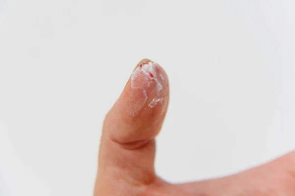 Намотаний Палець Червона Кров Великому Пальці Палець Оброблений Маззю Після — стокове фото
