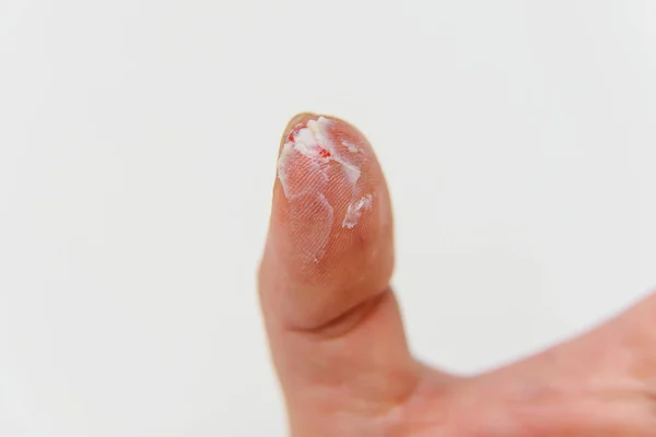 Wunde Finger Scharlachrot Daumen Ein Mit Salbe Behandelter Finger Nach — Stockfoto