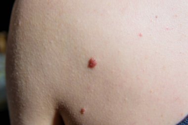 Kahverengi koyu köstebek. Kanser tümörü. İnsan cilt yapısı. İnsan vücudunun omuz eklem indirdiğimde benler.