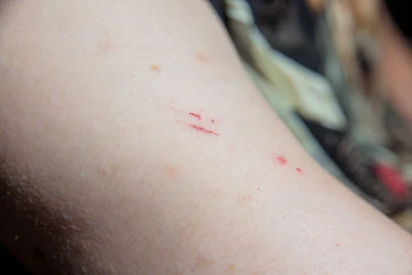 Mosquito bite on hand. Human leg. Skin structure Body hair Damaged skin. Sore. The man. Human body. Scar. Scratch. Hand on the background of a dark T-shirt.