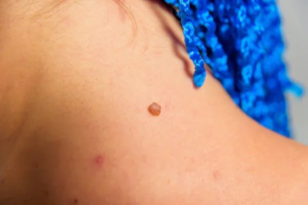 Hosszú Pigtailek Kék Zsinór Szövés Technika Bőr Egy Fül Anyajegyek — Stock Fotó