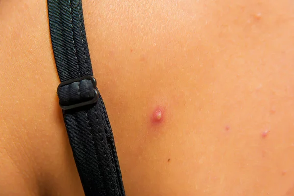肩关节皮肤纹理系带下胸罩 皮肤上的粉刺 炎症过程 身体上的摩尔 — 图库照片