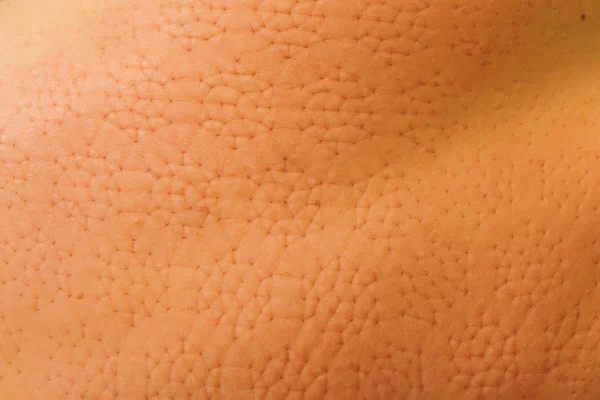 Massagematte Für Den Rücken Markierungen Auf Der Haut Durch Den — Stockfoto