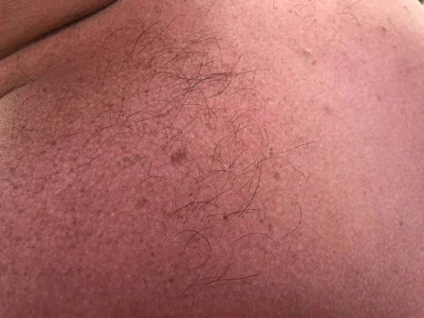 赤い日焼けした男性の背中 背中のそばかす 太陽の燃える肌の質感 皮膚の表面のそばかす — ストック写真