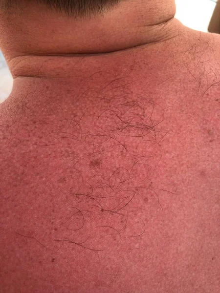 Red Tanned Male Back Freckles Back Texture Skin Sun Burn — Stock Photo, Image