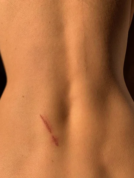 抓伤了那个女人的背 人体皮肤质地 一个男人背上的擦伤身体上的皮肤被划伤 — 图库照片