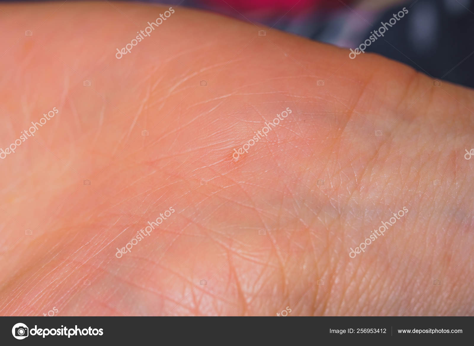 papillomavírus kezét
