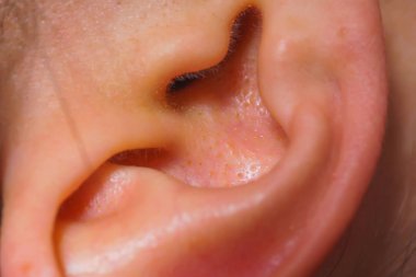 Kadın kulakları çekim. Kulakların iltihaplı derisi. Akne ve siyah noktalar ile auricle kızlar.