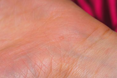 Avuç içi cildin dokusu. Papilloma virüsü ilk aşamada ellerde. Eldeki yaşam hatları.