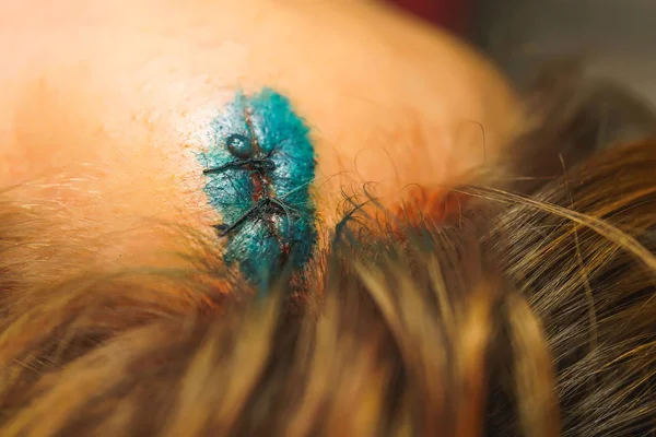 Head wound after a car accident. Brilliant green solution on the forehead. Head injury. Wound treatment with a disinfectant. Stitching on the scalp.