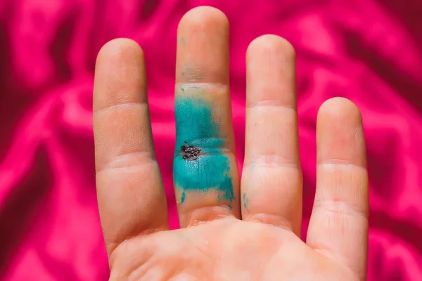 Ferida Dedo Uma Solução Diamante Verde Dedo Danos Nos Tendões — Fotografia de Stock