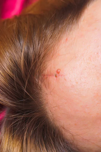 Head wound after a car accident. A fresh scar on the forehead. Head injury. Removal of sutures from the head.