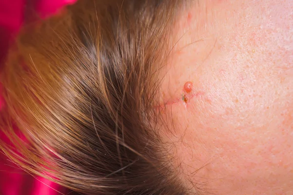 Head wound after a car accident. A fresh scar on the forehead. Head injury. Removal of sutures from the head.
