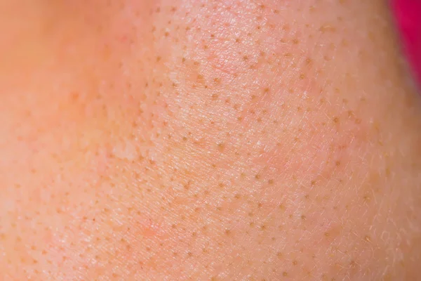 Weiße Frauenhaut Aus Nächster Nähe Entzündungen Und Pickel Gesicht Problemhaut — Stockfoto