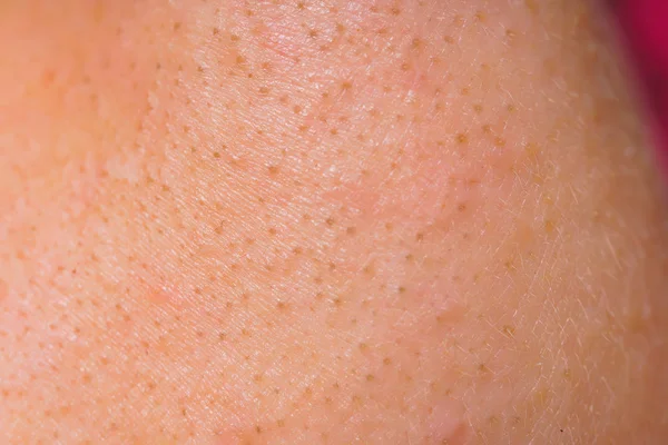 白人女性の肌が閉じます 顔に炎症や吹き出物 にきびと黒い斑点との問題の皮膚 — ストック写真