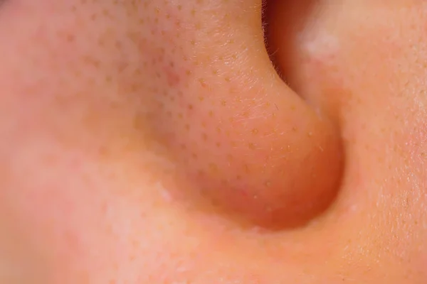 Black Dots Nose White Woman Skin Close Inflammation Acne Skin — Stock Photo, Image