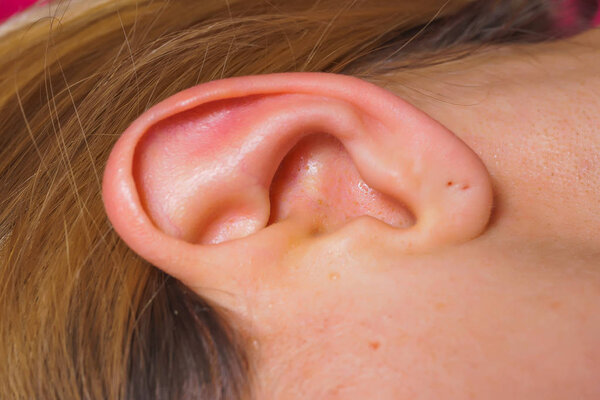 Женские уши крупным планом. Воспаленная кожа ушей. Девочки с акне и черными точками
.