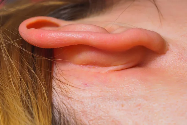 女性の耳のクローズアップ 耳の炎症肌 にきびと黒い点を持つ耳介の女の子 — ストック写真