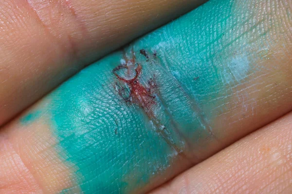 Poranění Prstu Roztok Zeleného Diamantu Prstu Poškození Šlach Prstu Ruce — Stock fotografie