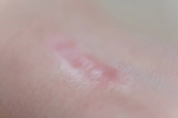 Cicatriz Pulso Rapariga Textura Cicatriz Pele Superfície Danificada Pele Uma — Fotografia de Stock