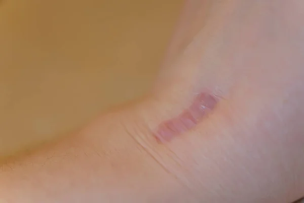Una Cicatriz Muñeca Chica Textura Cicatriz Piel Superficie Dañada Piel — Foto de Stock